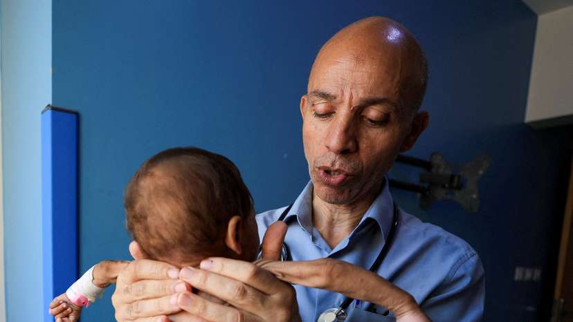 Palestinian doctor Ahmed Basal examines a child for malnutrition at Al-Rantisi Hospital in Gaza City