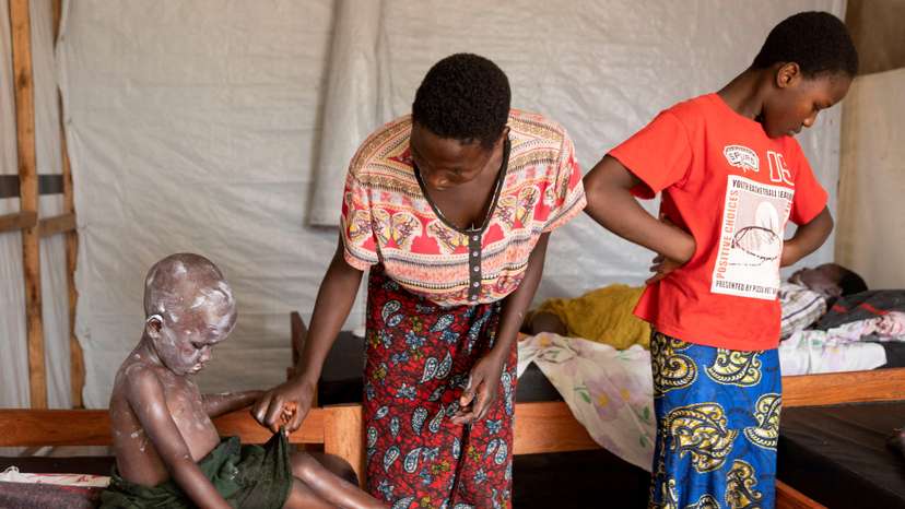 Mpox surge in Central Africa exposes awareness gap