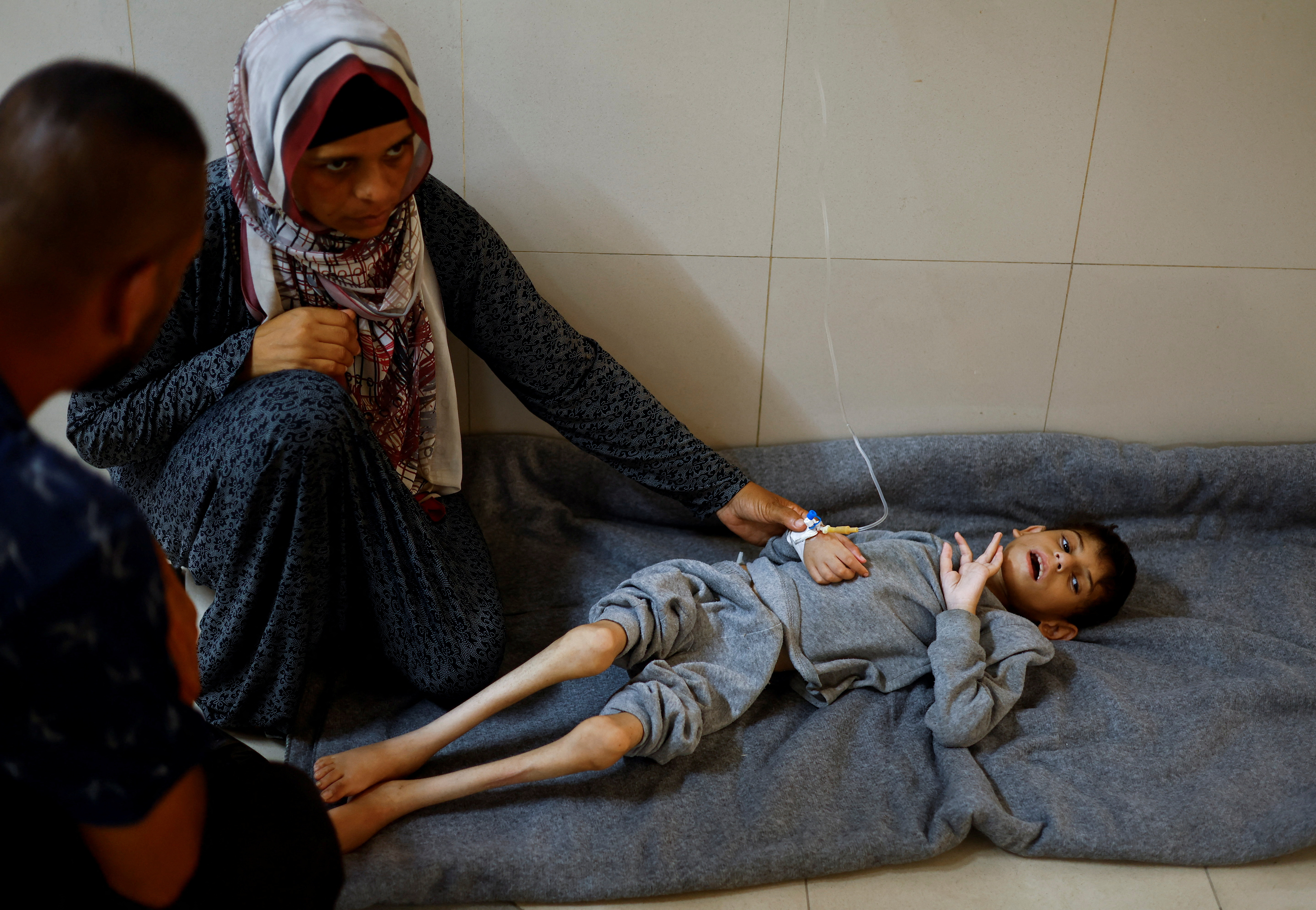 Younis Joma, a malnourished Palestinian boy, receives treatment at at Nasser hospital in Khan Younis, in the southern Gaza Strip