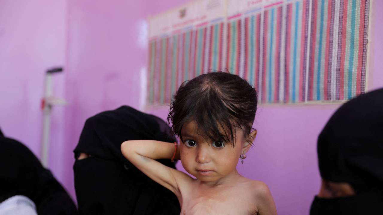 FILE PHOTO: Yemeni children face risks of medical complications amid high levels of food insecurity