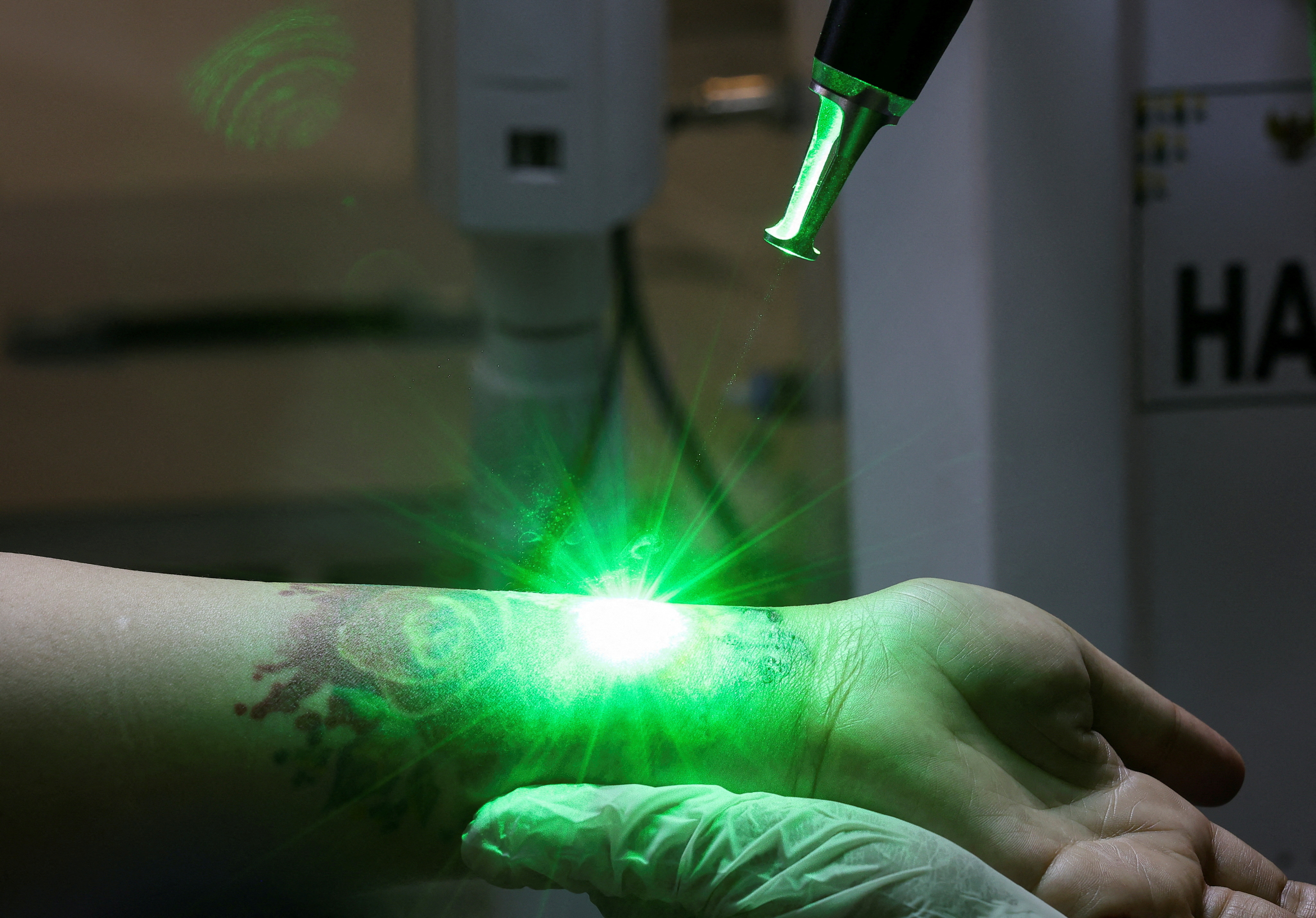 FILE PHOTO: Free tattoo removal program during the holy month of Ramadan at the Central Jakarta Mayor's Office in Jakarta