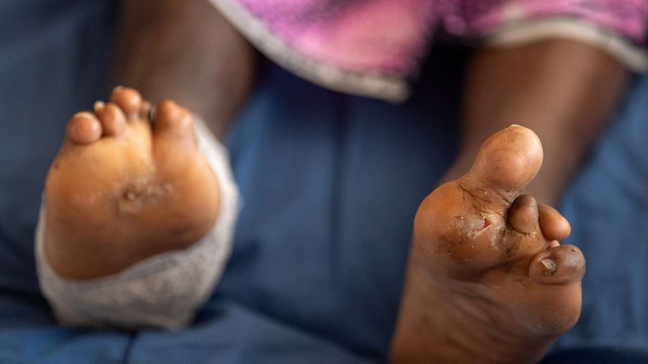 Nigeria to receive leprosy drugs after a year-long delay