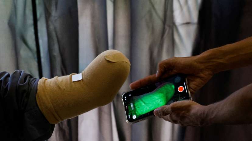 Technician uses a mobile phone for 3D scan of a patient before develping a prosthetic limb at the Bioniks Private Limited, in Karachi