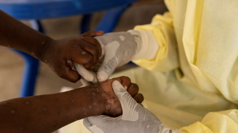 Children at risk as mpox variant hits Congo displacement camps