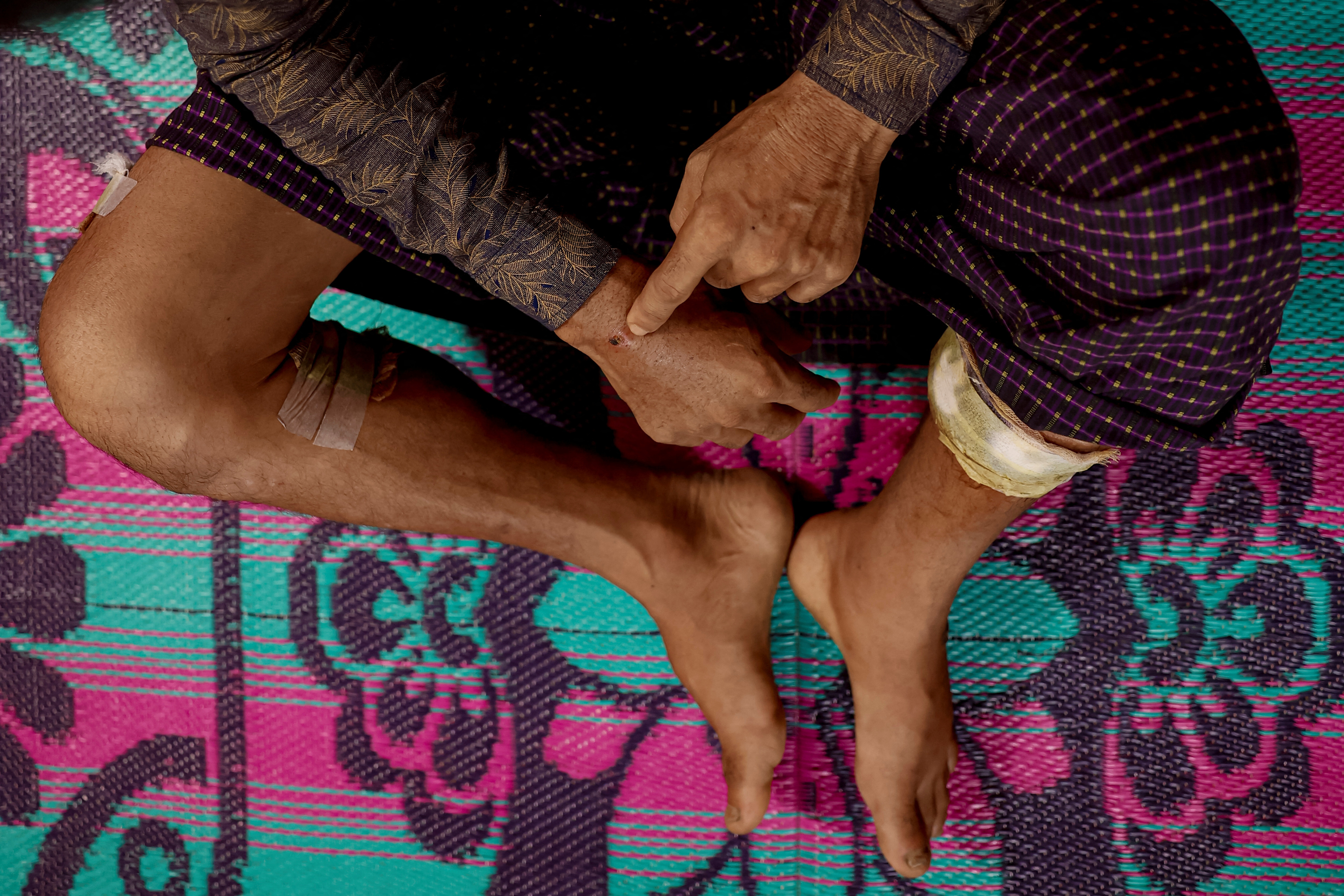 A Rohingya Muslim man who fled to Bangladesh from Maungdaw township of Myanmar after being injured in a drone attack