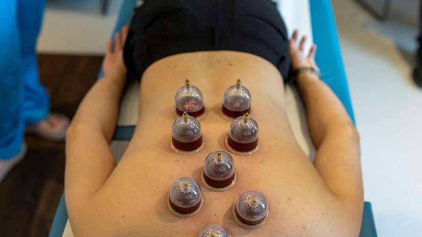 Cupping, leeching, and other ancient healing methods welcomed in modern Turkish hospitals