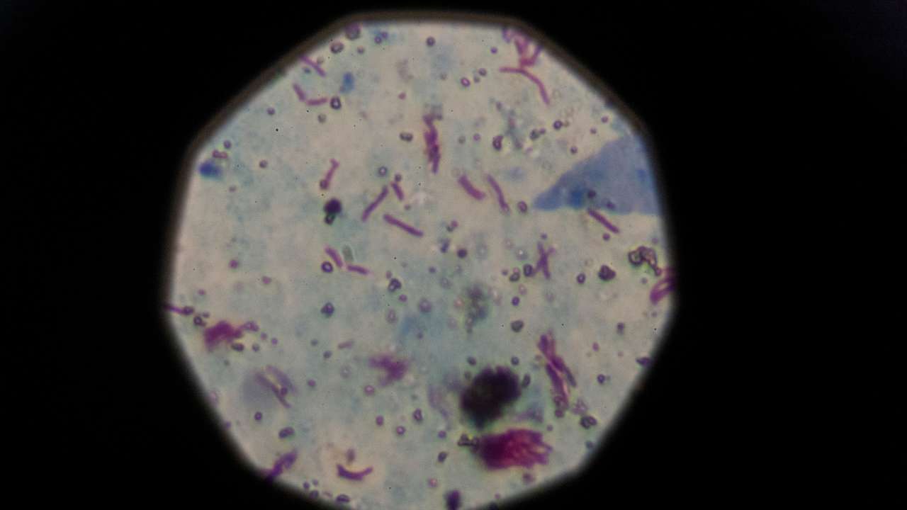 The Wider Image: 'White death' in Argentina: The hunger of poverty feeds tuberculosis