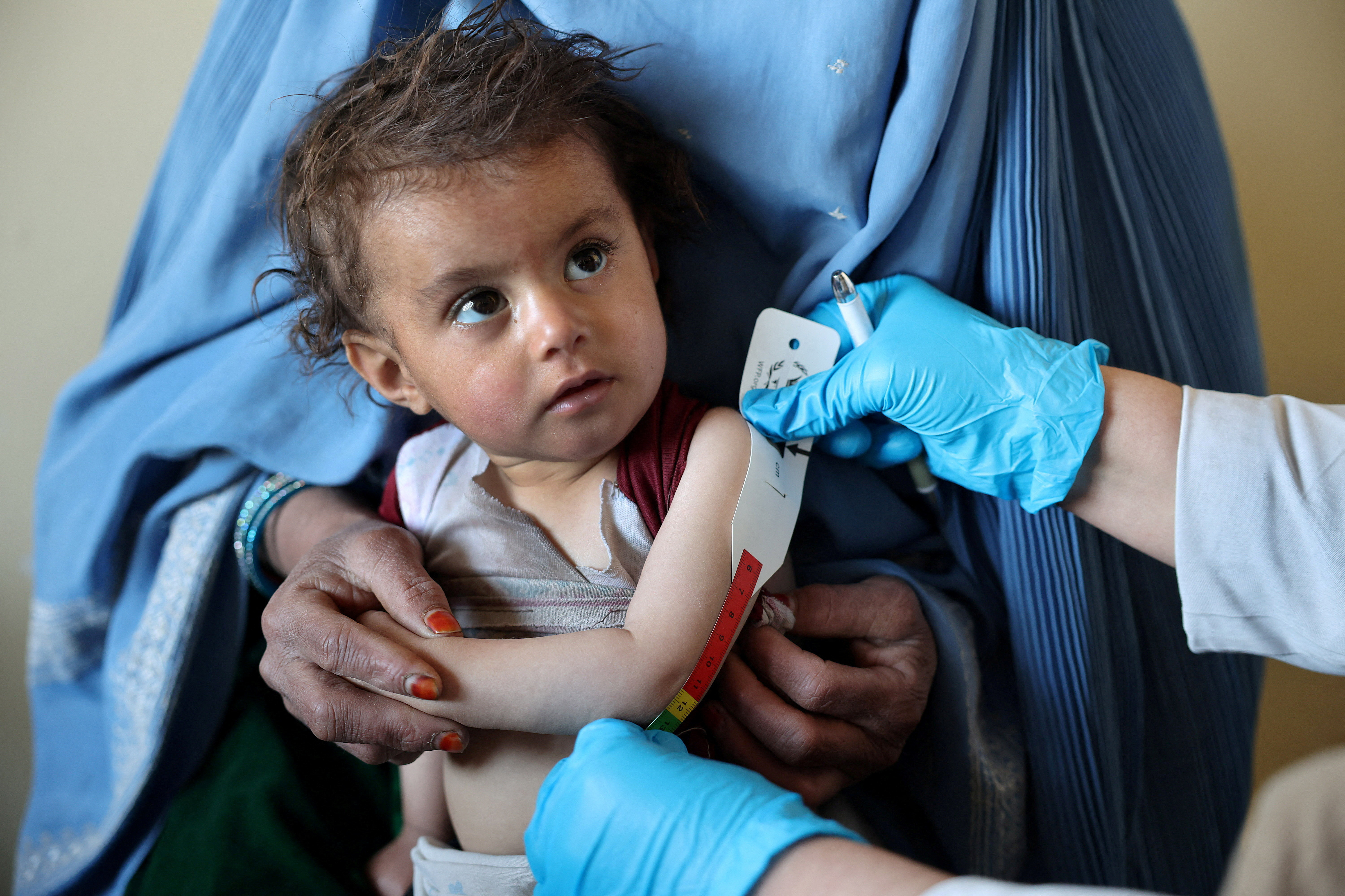 An Afghan girl looks the doctor as he measure her upper arm at the WFP-supported Qasaba Clinic, in Kabul