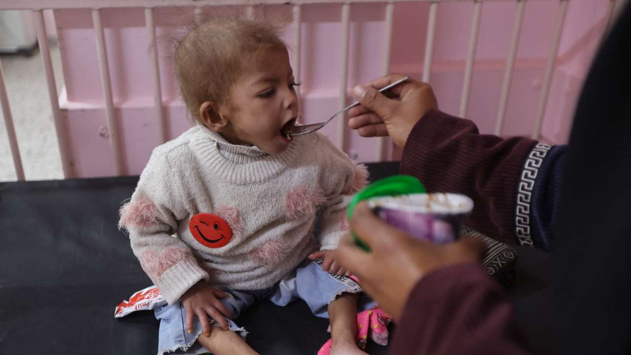 Arjwan Al-Dahini, a Palestinian child, who doctors say suffers from severe acute malnutrition, sits on a hospital bed while being fed by her mother, at Nasser Hospital in Khan Younis