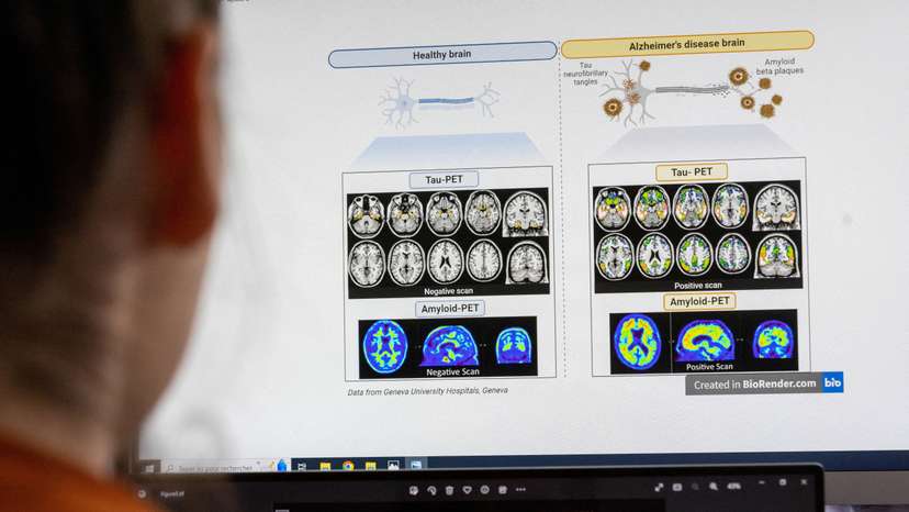 FILE PHOTO: A scientist looks at scans of brains at the Memory Centre at the Department of Readaptation and Geriatrics of the University Hospital (HUG) in Geneva
