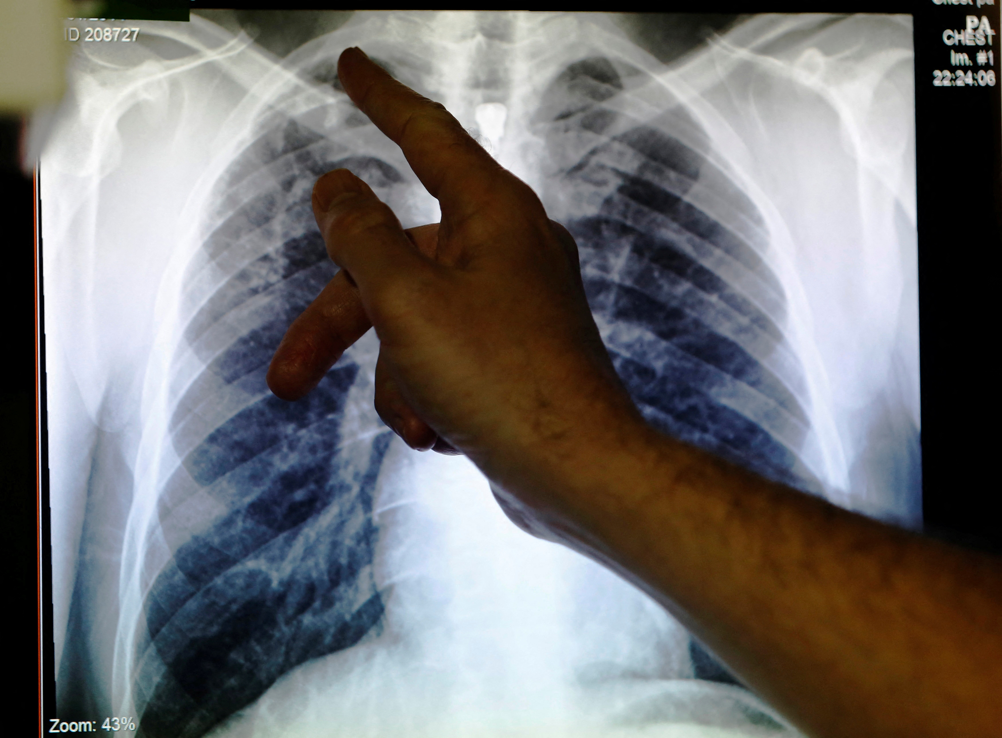 FILE PHOTO: Clinical lead Doctor Al Story points to an x-ray showing a pair of lungs infected with TB (tuberculosis) during an interview with Reuters  on board the mobile X-ray unit screening for TB in Ladbroke Grove in London