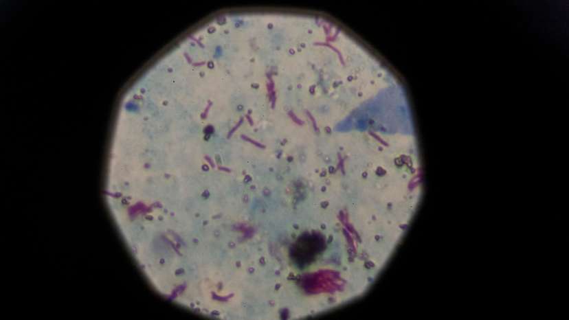 The Wider Image: 'White death' in Argentina: The hunger of poverty feeds tuberculosis