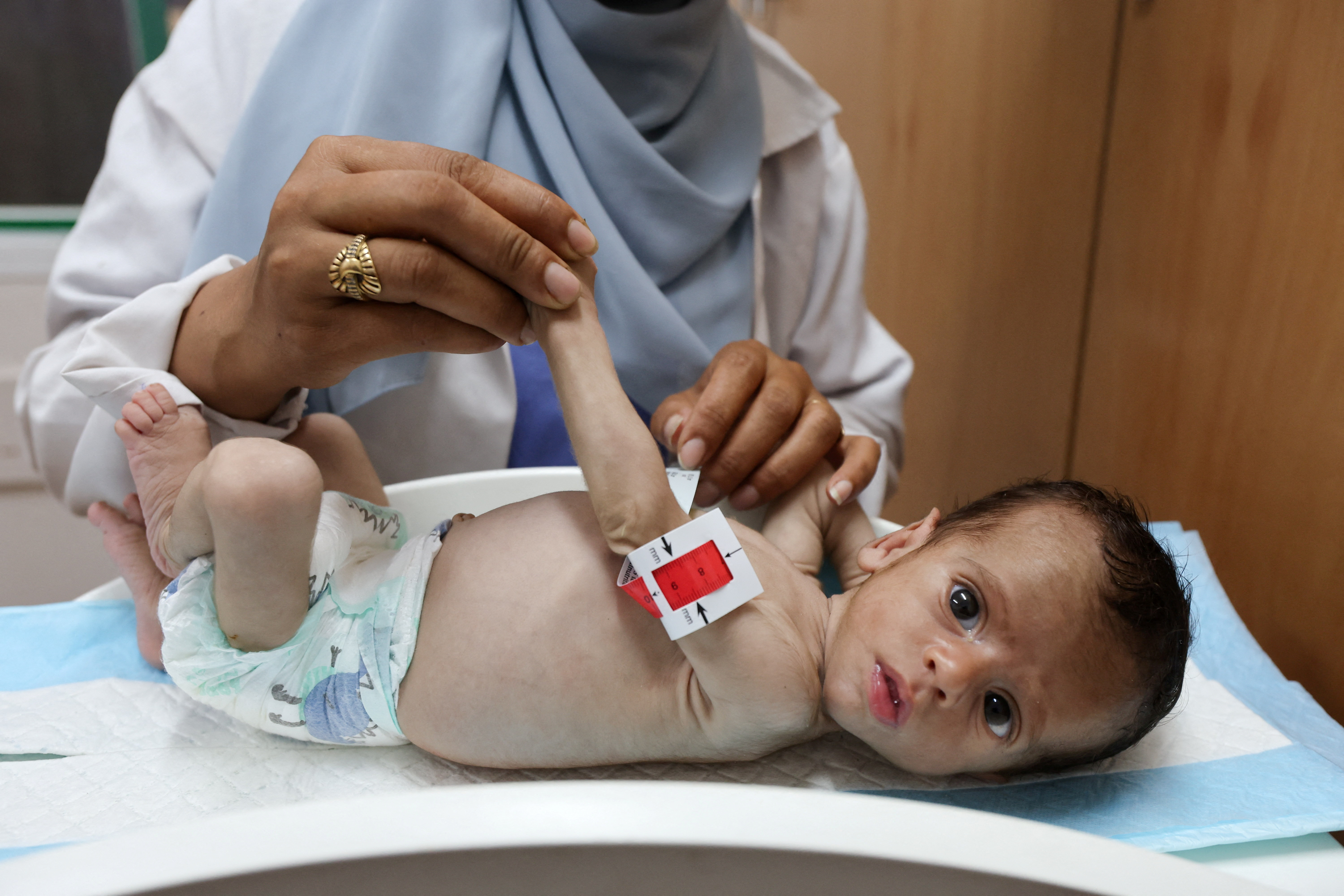 On Gaza malnutrition ward, a child's limb is as wide as a mother's finger in Khan Younis