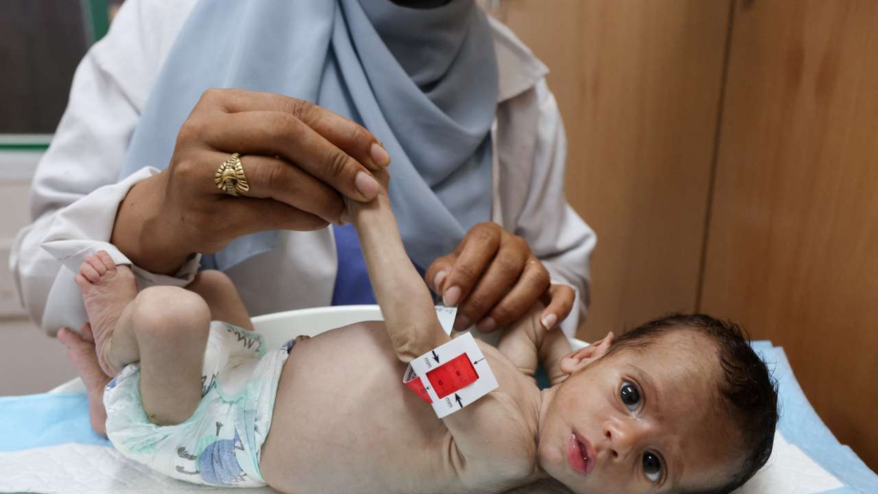 On Gaza malnutrition ward, a child's limb is as wide as a mother's finger in Khan Younis