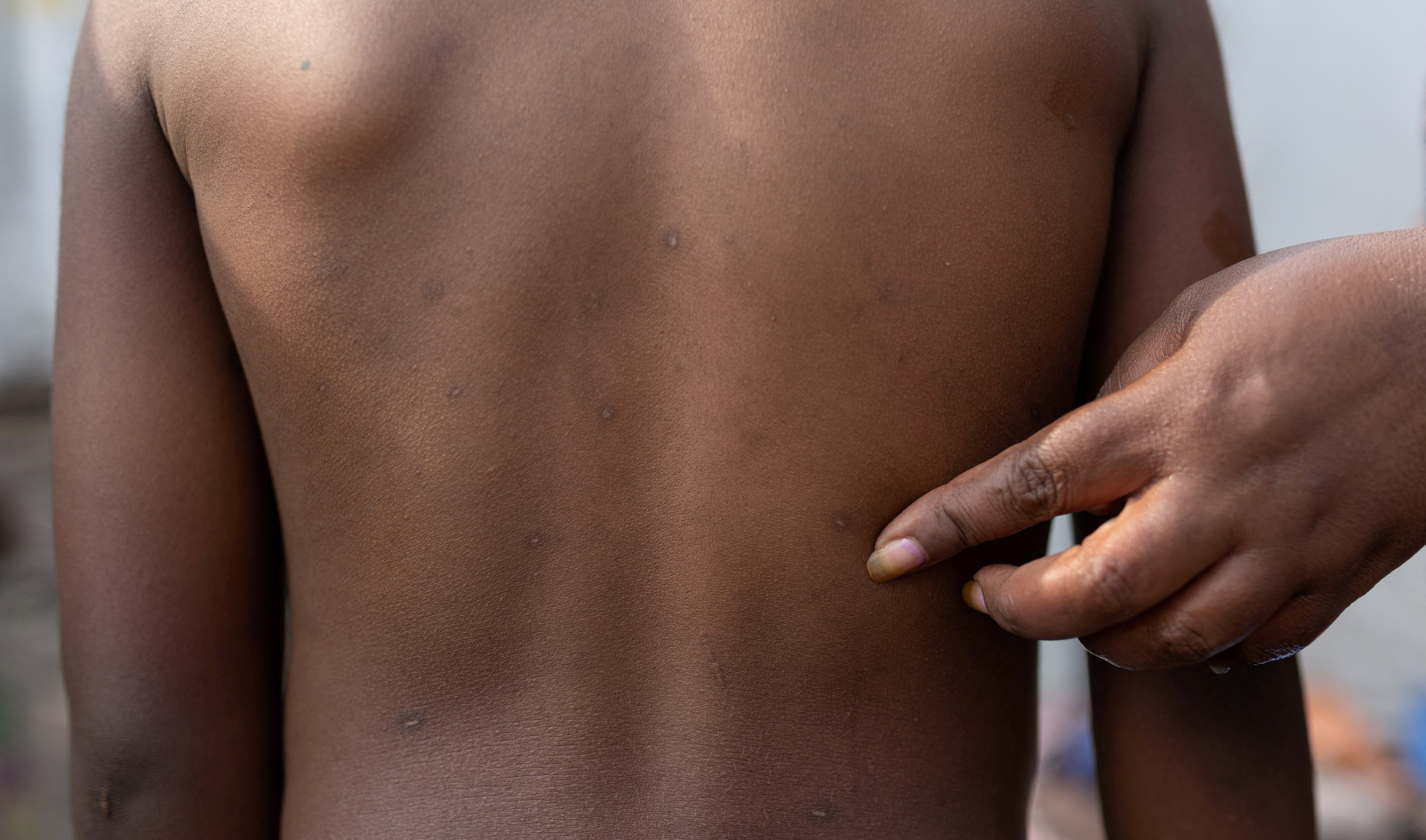 FILE PHOTO: Rash marks on child in  Congo, who recovered from mpox