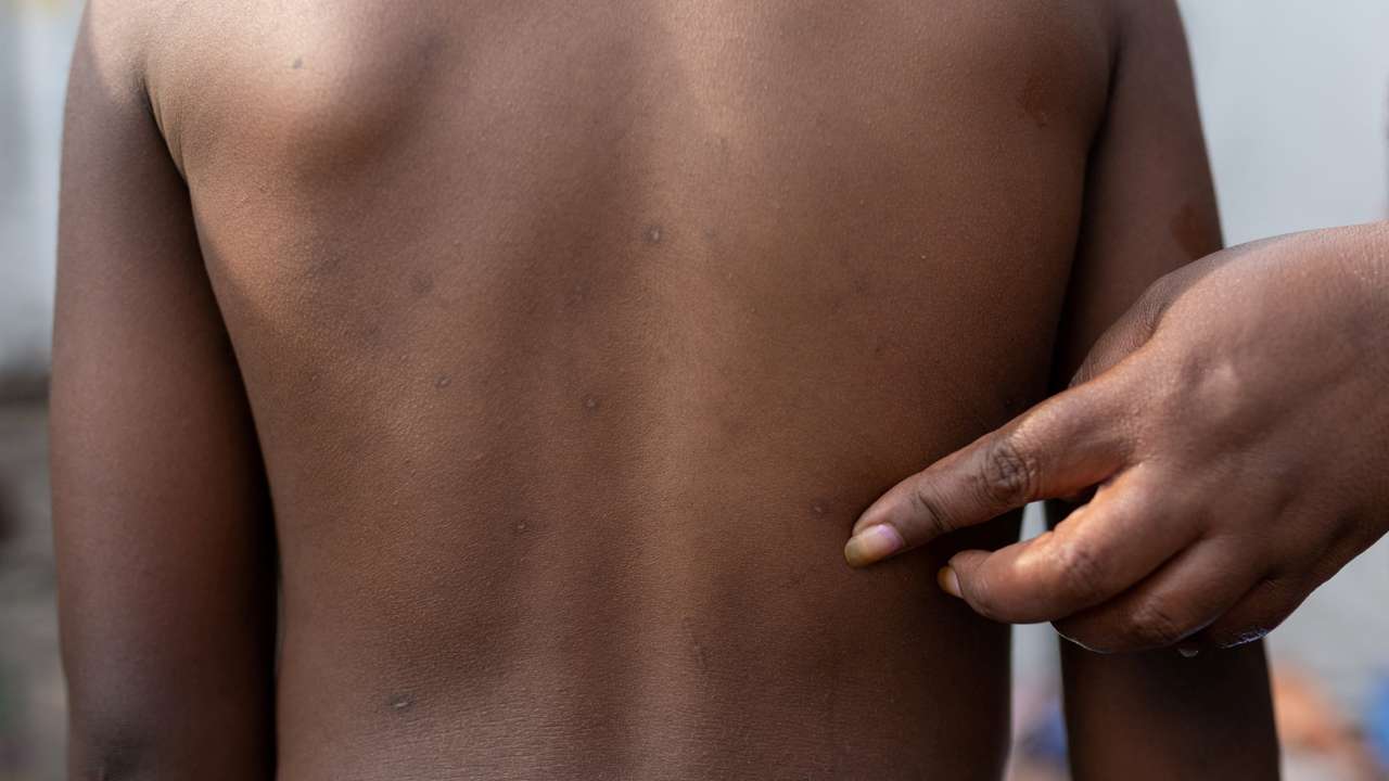 FILE PHOTO: Rash marks on child in Congo, who recovered from mpox
