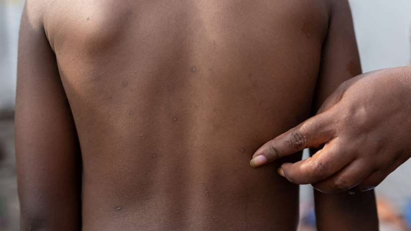 FILE PHOTO: Rash marks on child in Congo, who recovered from mpox