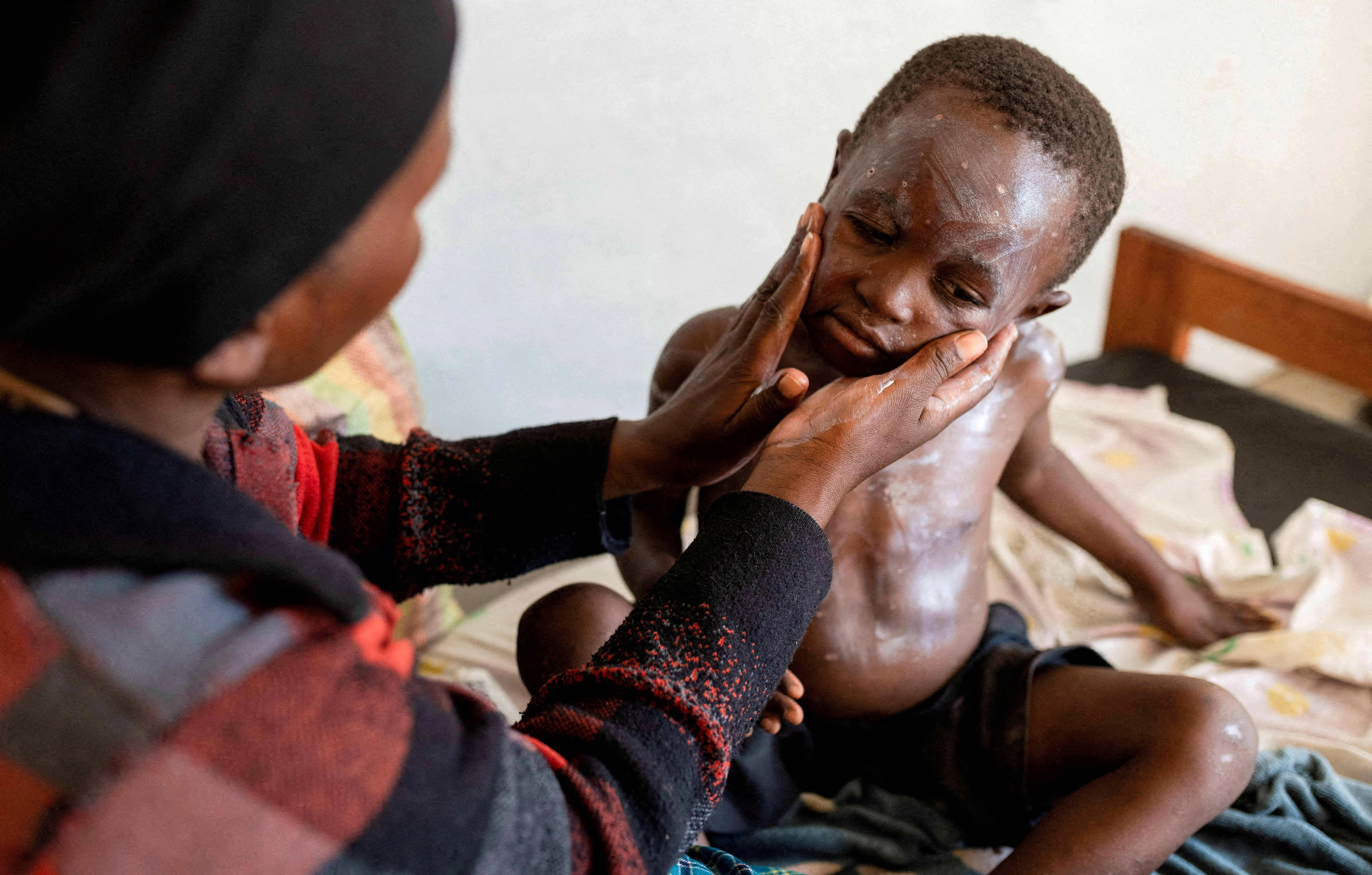 FILE PHOTO: Furaha Elisabeth applies medication on the skin of her child Sagesse Hakizimana who is under treatment against Mpox in Munigi