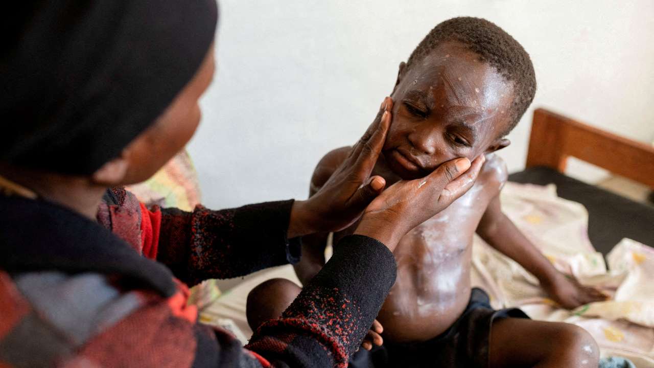 FILE PHOTO: Furaha Elisabeth applies medication on the skin of her child Sagesse Hakizimana who is under treatment against Mpox in Munigi