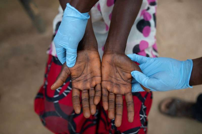 The Wider Image: In Africa's monkeypox outbreak, sickness and death go undetected