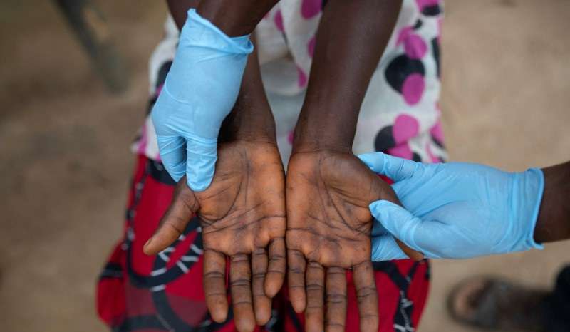 The Wider Image: In Africa's monkeypox outbreak, sickness and death go undetected