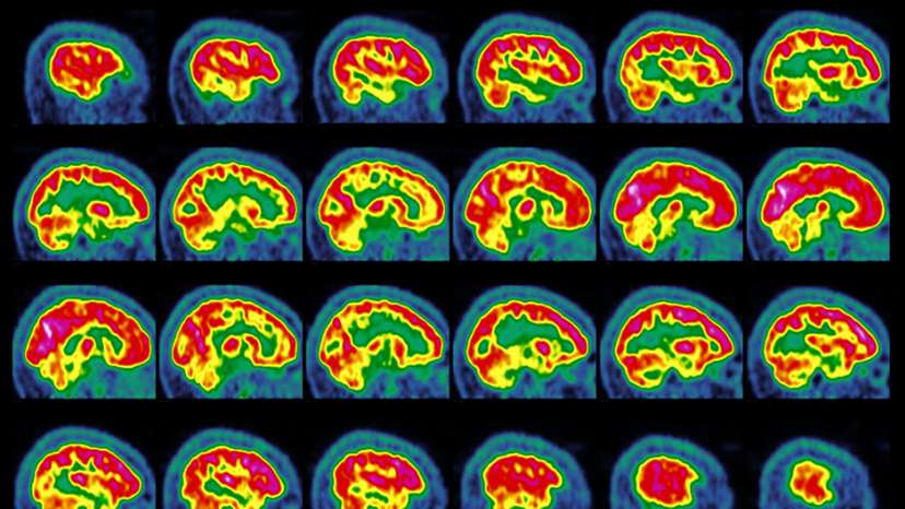 Temporal lobe epilepsy, PET scans
