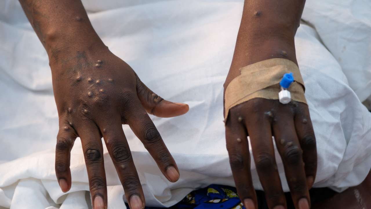 The hands of a patient with skin rashes caused by the mpox virus are pictured in Kinshasa