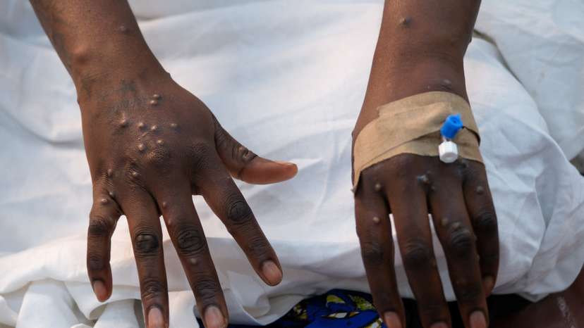 The hands of a patient with skin rashes caused by the mpox virus are pictured in Kinshasa